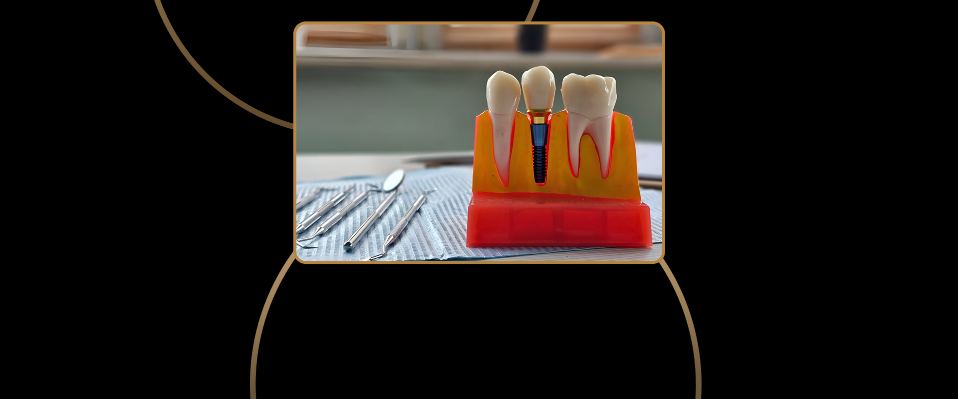 Dental Implant Process